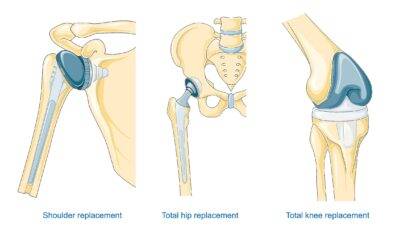 Understanding Knee, Hip and Shoulder Joint Replacement Surgeries