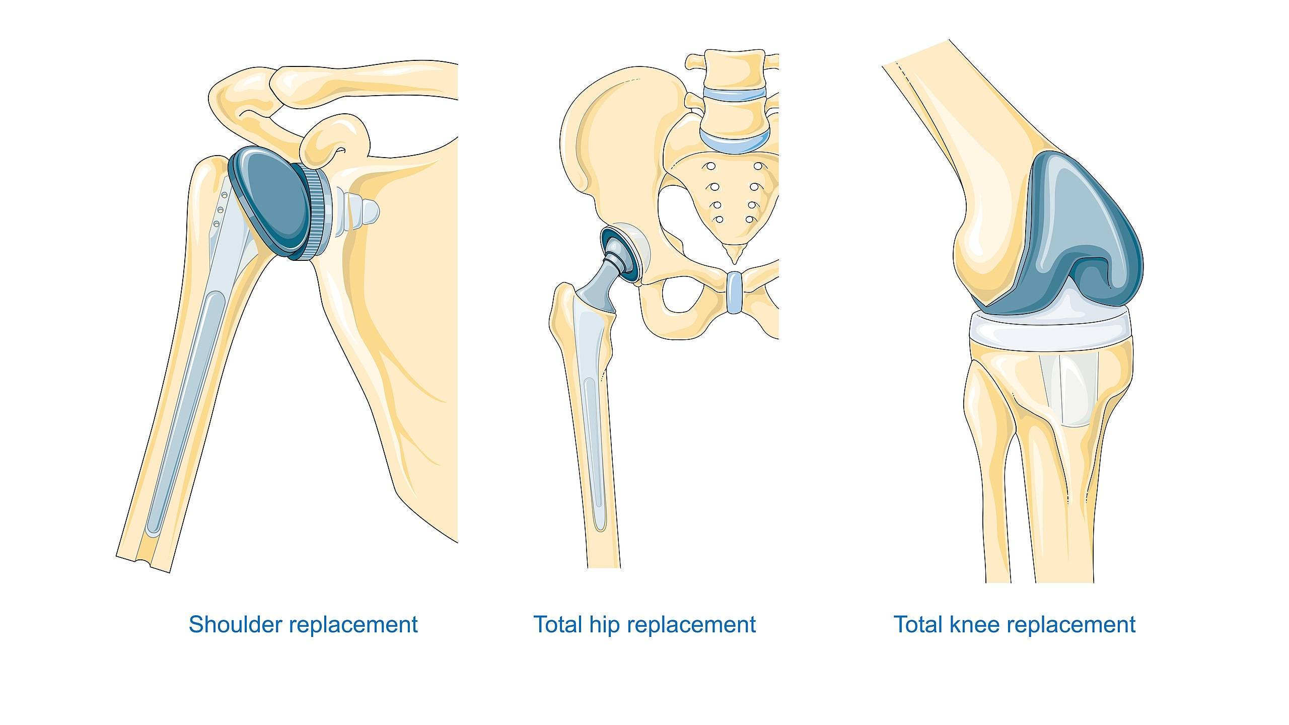 joint replacement surgeries